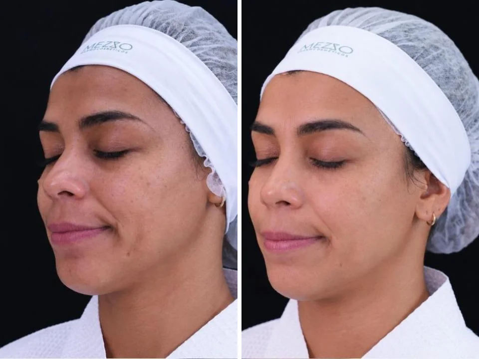 Antes e depois com PDRN TETRA, caso 1