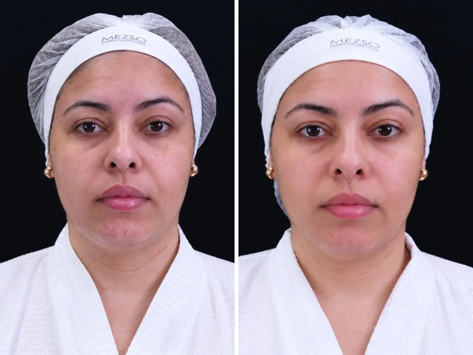 Antes e depois com PDRN TETRA, caso 2