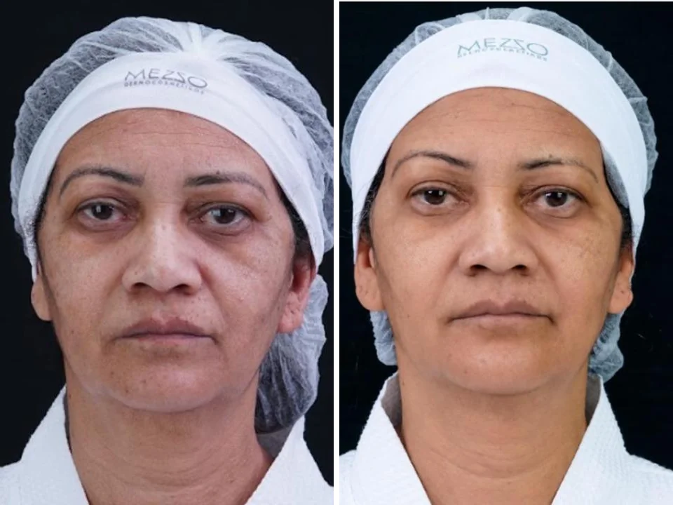 Antes e depois com PDRN TETRA, caso 3