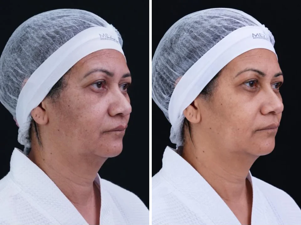 Antes e depois com PDRN TETRA, caso 4