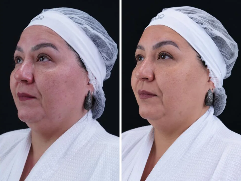 Antes e depois com PDRN TETRA, caso 5