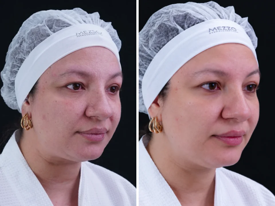 Antes e depois com PDRN TETRA, caso 6